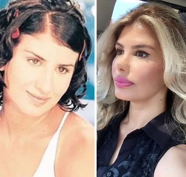 Şarkıcı Hatice botokstan zehirlendi! Son görüntüsü korkuttu.....
