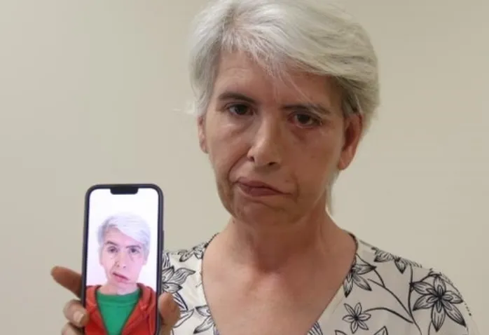 Yüz felci nedeniyle yıllarca açık gözle uyuyan kadın, Eskişehir